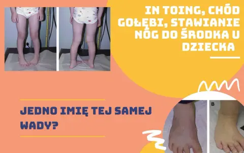 Dziecko z kaczym chodem, stawiające nogi do środka. Dwa zdjęcia pokazują tę samą wadę u dziecka.