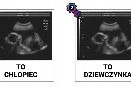 USG pokazuje płód. Po lewej "TO CHŁOPIEC", po prawej "TO DZIEWCZYNKA". Obrazki pomagają rozpoznać płeć dziecka usg dziewczynka.